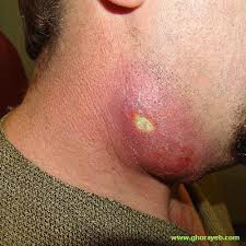 Steroid injection for acne side effects