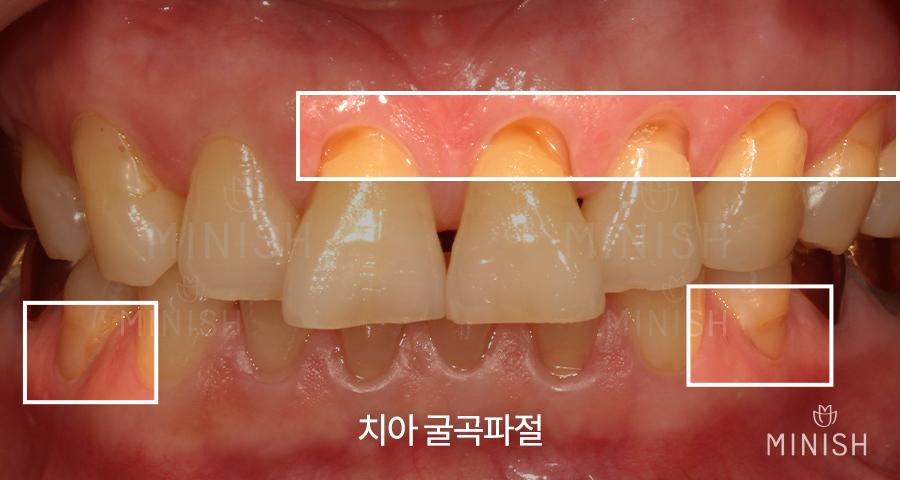 치과_치은퇴축_잇몸퇴축_잇몸내려앉는 증상2.jpg